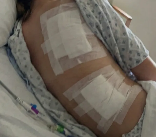 Ferimentos nas costas da Fernanda